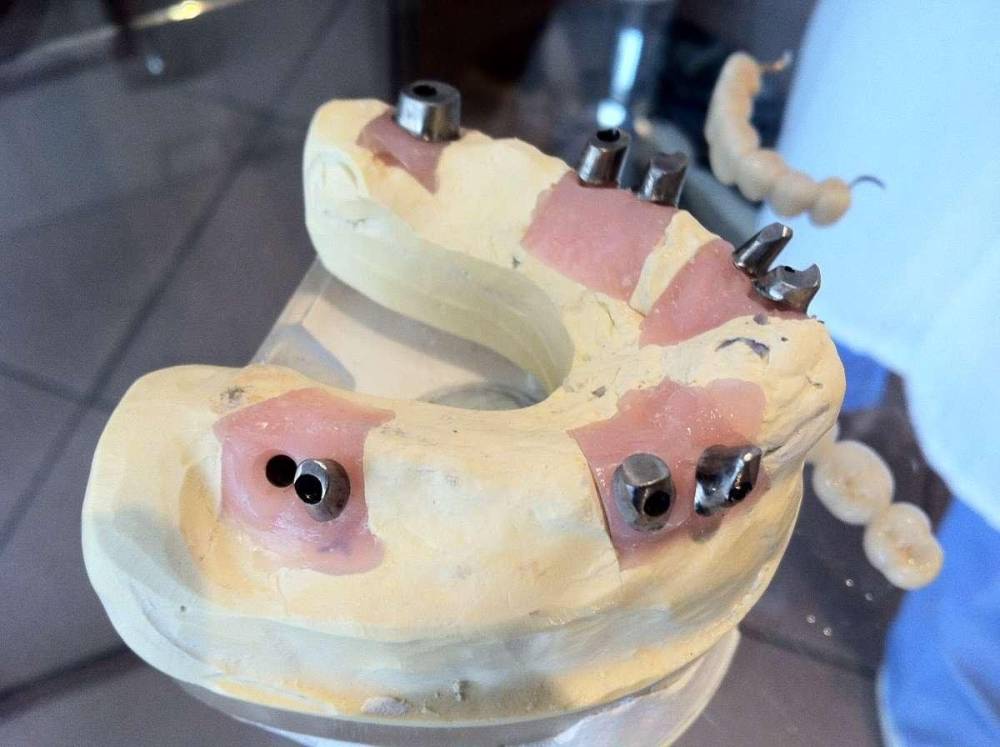 implants dentaire