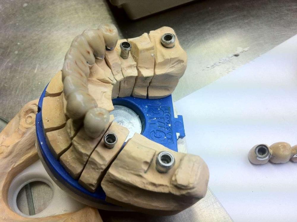 implants dentaire